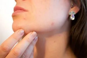 Pozbyć się pryszcza szybko w dzień? Naturalne sposoby!